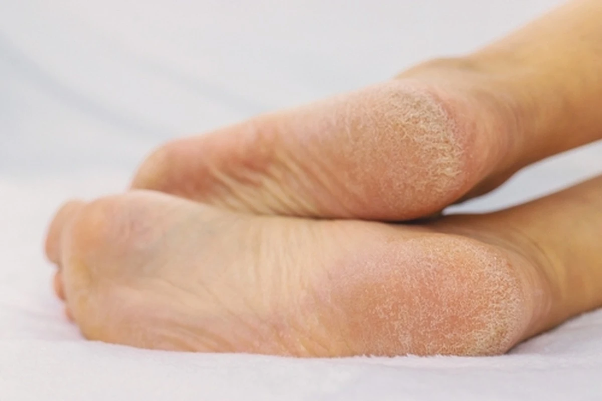 Tus talones gritan: No es sequedad, es una señal de alerta de tu cuerpo