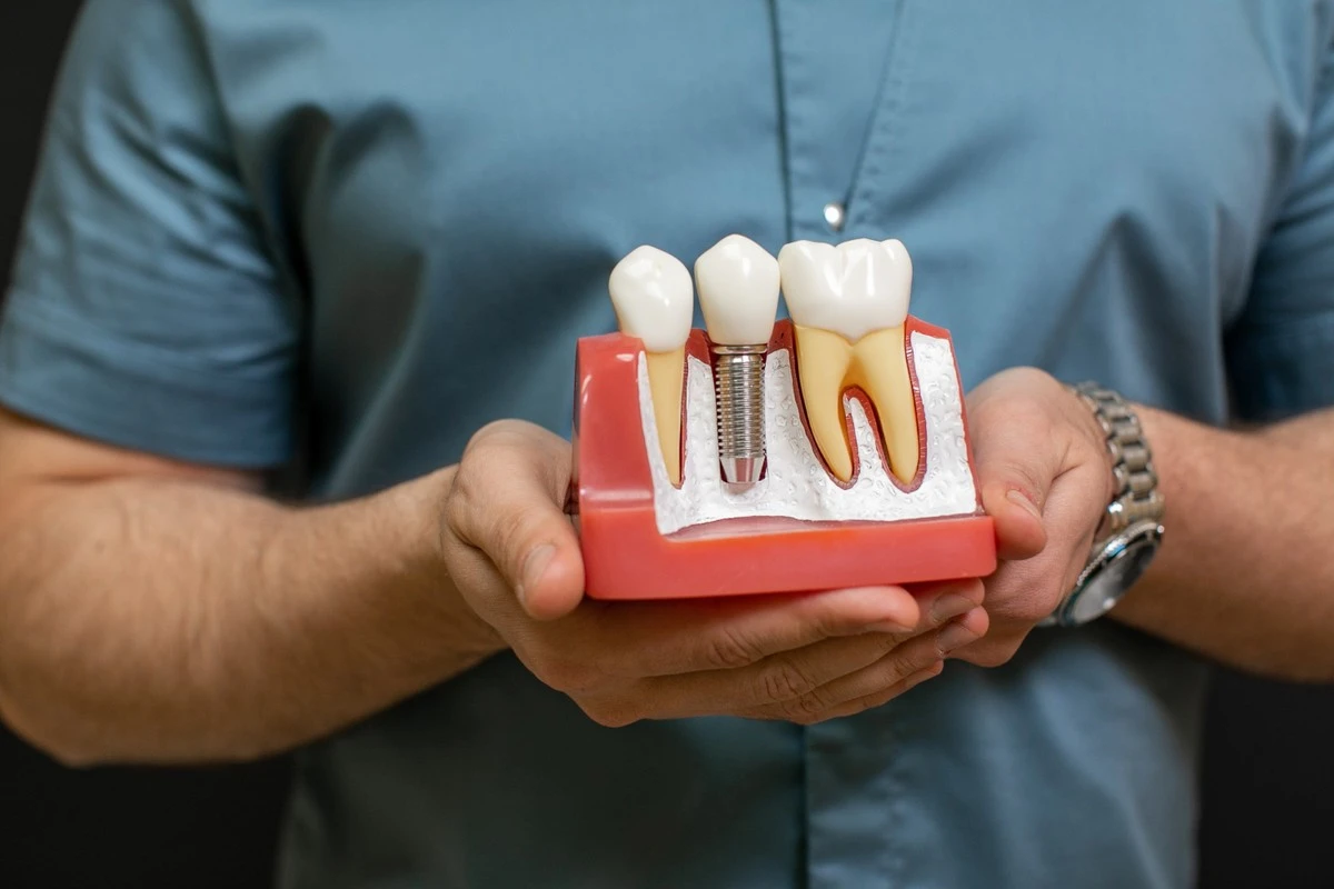 Por qué los dentistas recomiendan implantes para evitar problemas óseos a largo plazo