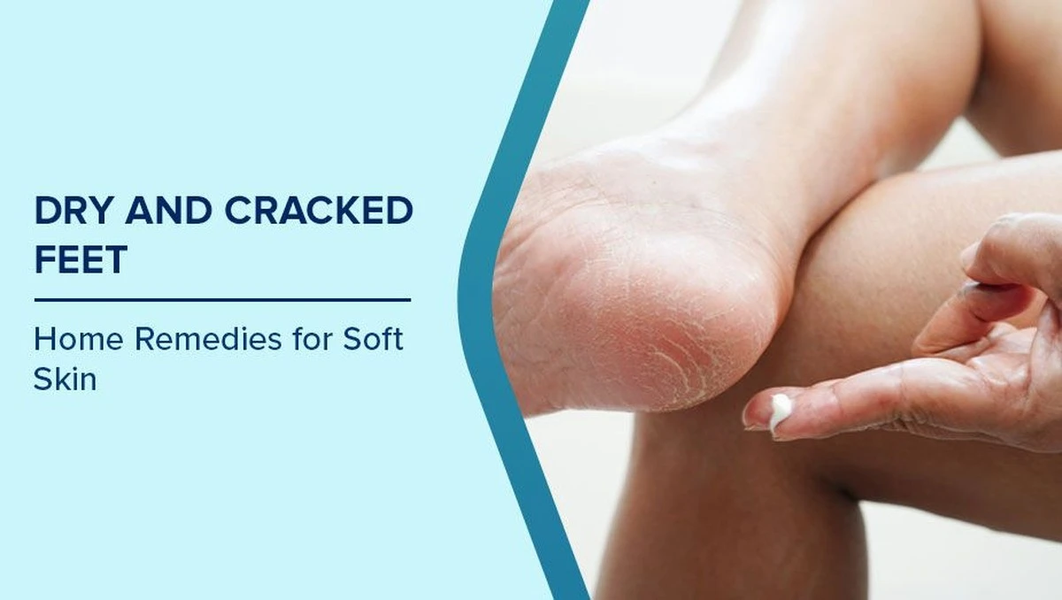 Culpa al frío: Por qué tus talones se agrietan en invierno y cómo un simple vegetal puede ser la solución - image 1