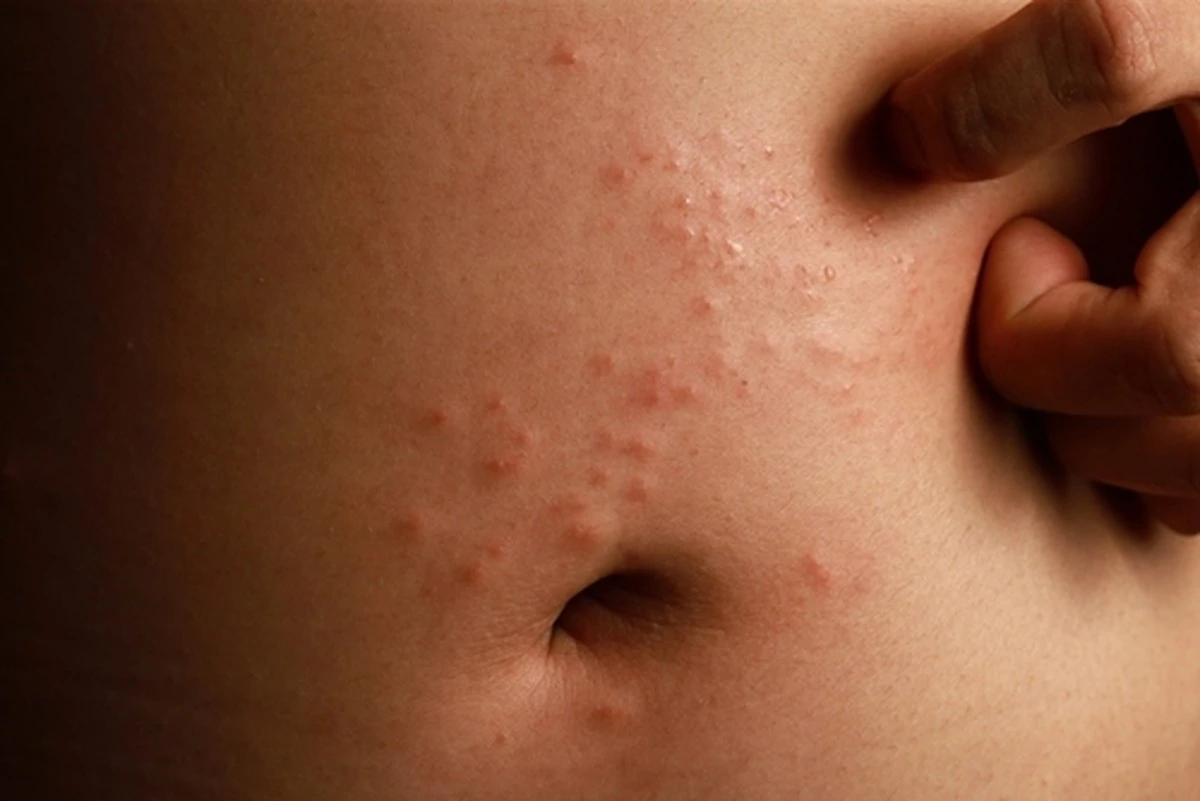 Si ves esta marca roja en tu piel, corre al médico el mismo día