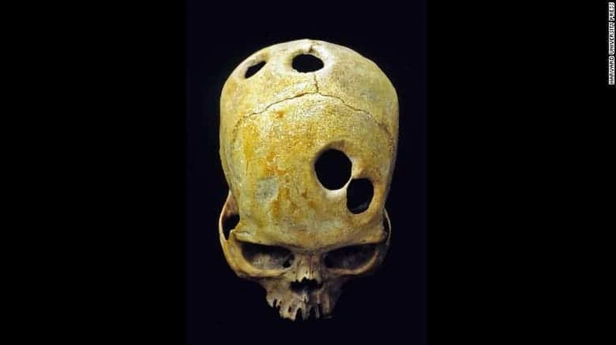 La trepanación inca: hace 500 años operaban cerebros con éxito sin anestesia - image 1
