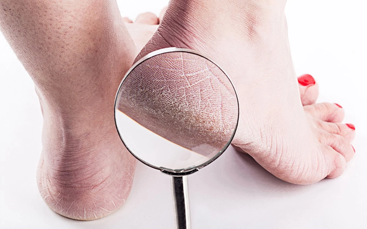 Tus talones gritan: No es sequedad, es una señal de alerta de tu cuerpo - image 1