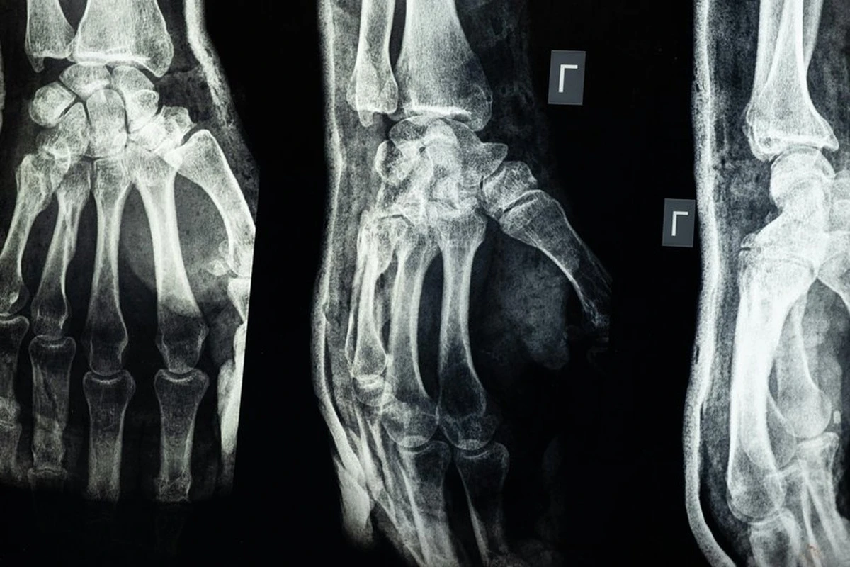 Por qué mi abuelo volvió a caminar tras una fractura usando cáscaras de huevo
