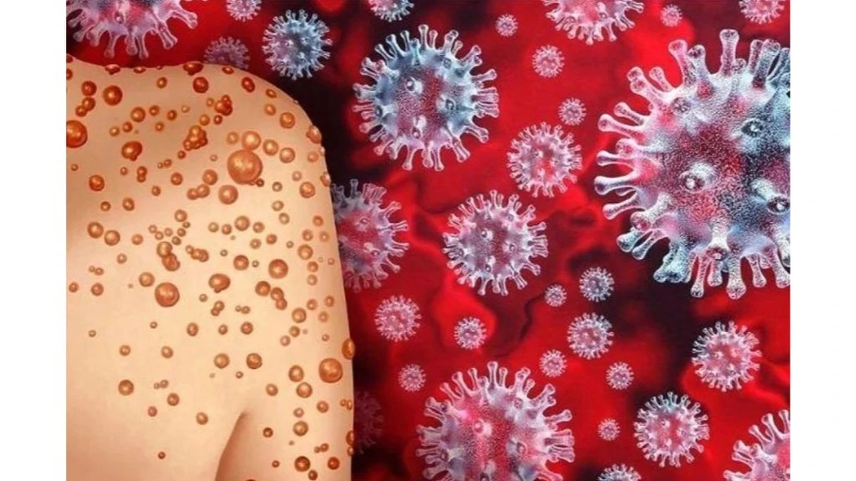 Mpox vs. COVID-19: entender las diferencias clave para no entrar en pánico