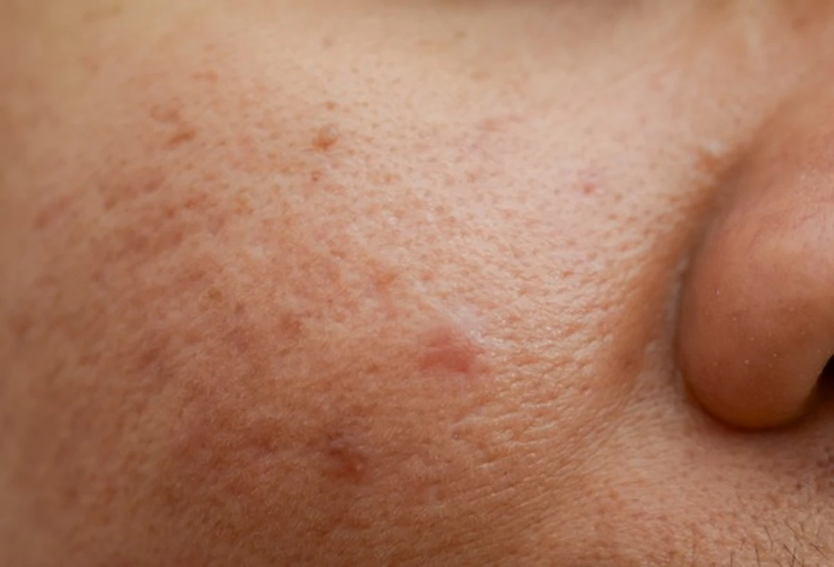 Adiós a las manchas marrones: el secreto de 2 ingredientes que tus dermatólogos no te cuentan