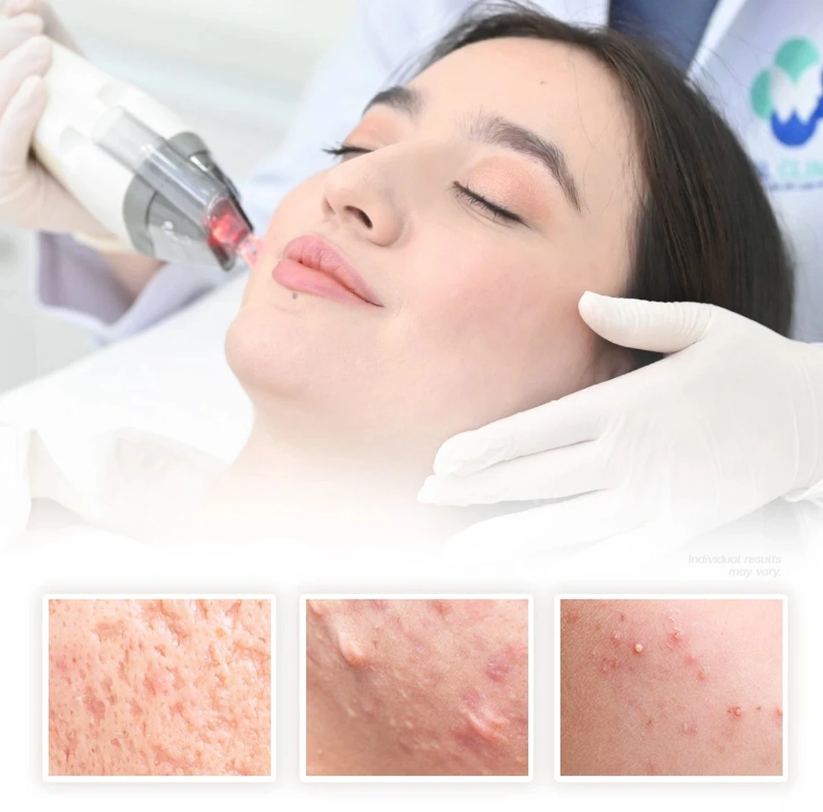 La verdad sobre el acné: lo que una dermatóloga me preguntó sobre mis malos hábitos - image 1