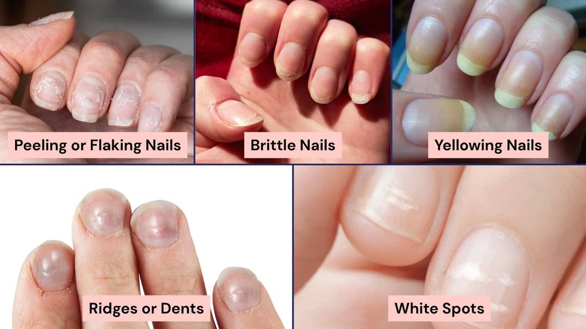 Tus uñas revelan señales ocultas de tu salud: Cómo interpretarlas - image 1