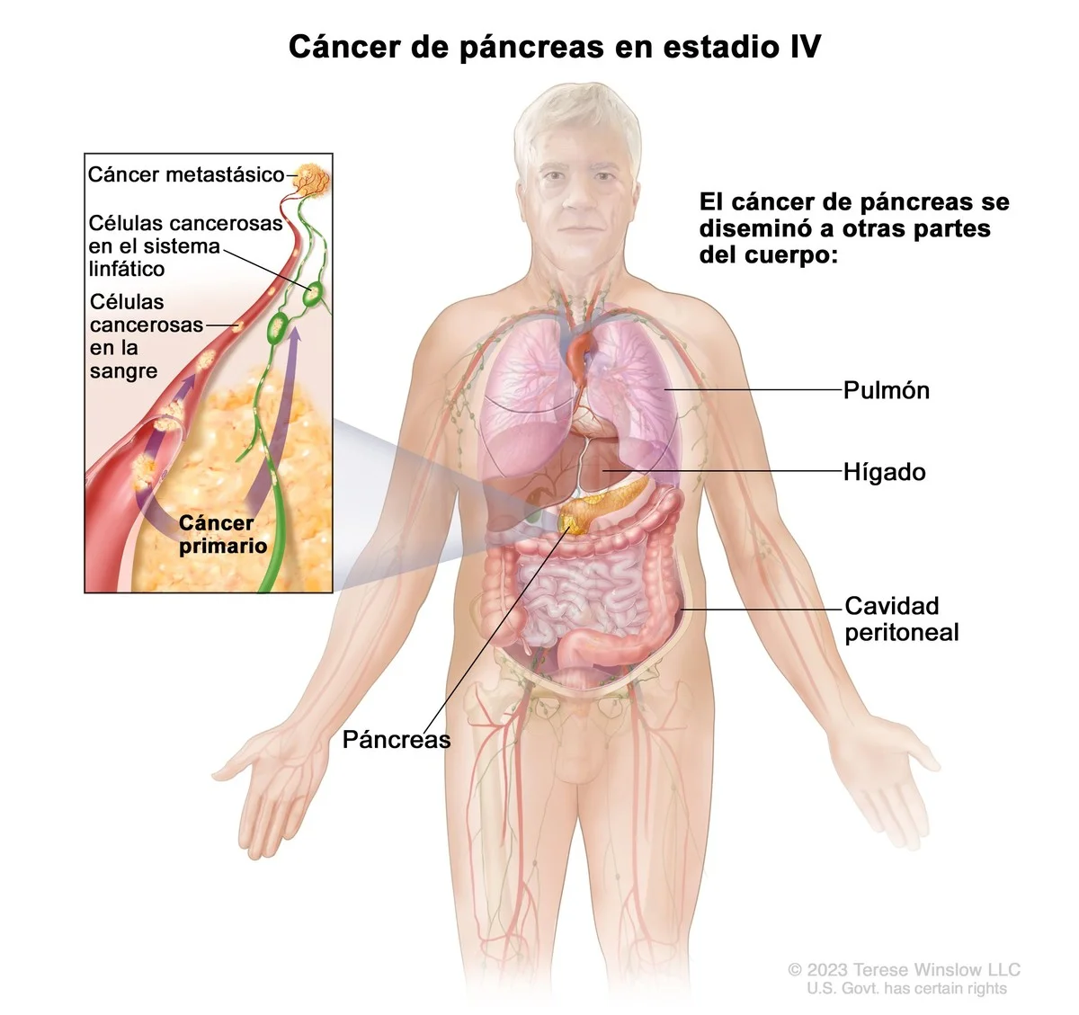 elcancerdepancr-extra-1.webp El cáncer de páncreas te avisa años antes: no ignores estas señales de alerta - image 1